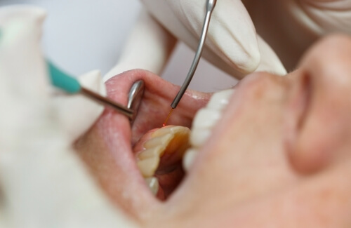 Close up of dentist treating a patient with a soft tissue laser