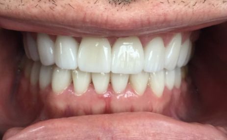 Close up of smile with straight white teeth after treatment from Orem dentist