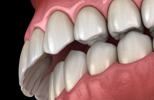An illustration of bite misalignment