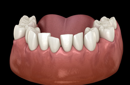 An illustration of crowded teeth