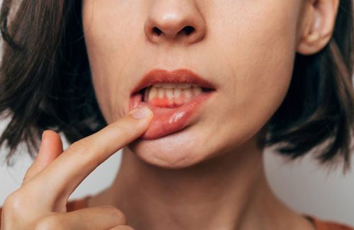 Lady shows inflamed gums