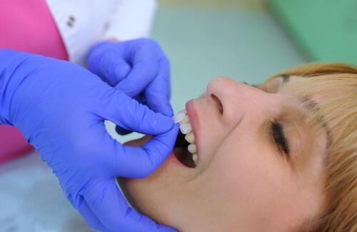 Dentist placing a veneer on a patients tooth