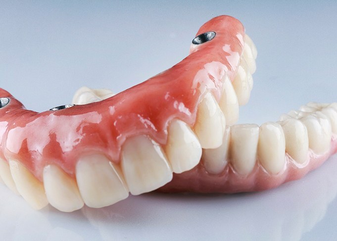 Implant dentures combine the convenience of dentures with the stability of dental implants