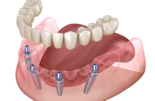 Implant dentures combine dentures and dental implants
