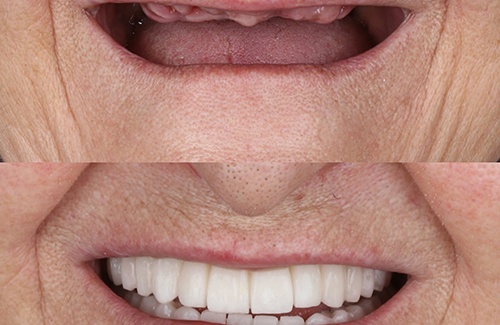 If you’re missing an entire arch of teeth you may be a good candidate for implant dentures