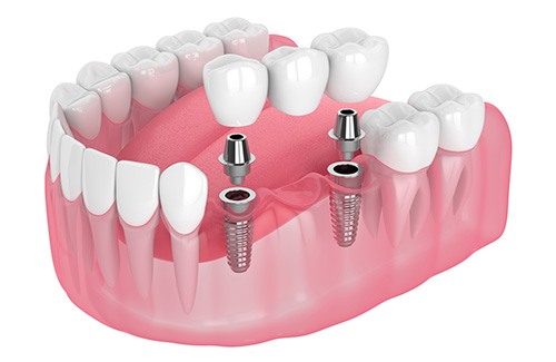 Illustration of an implant bridge