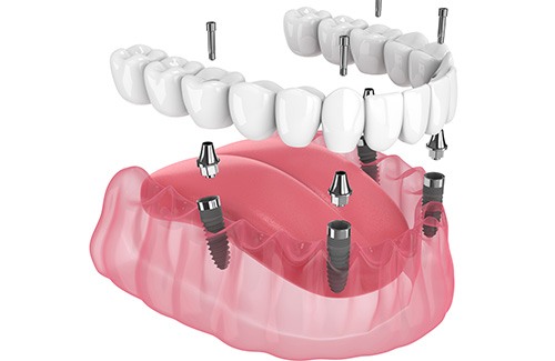 Illustration of an implant denture