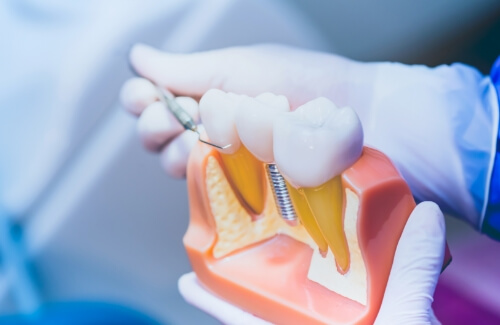 Dentist holding a model of a dental implant