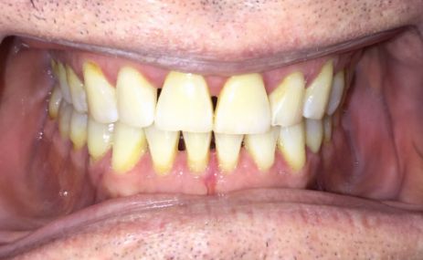 Close up of smile with discolored gapped teeth