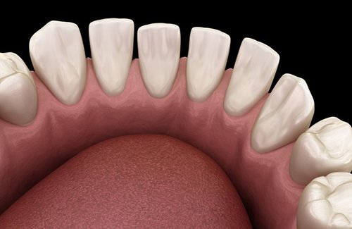 Illustration of teeth with gaps
