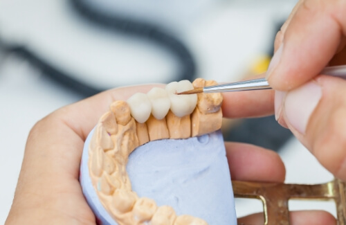 Ceramist creating a dental bridge in a model of the mouth