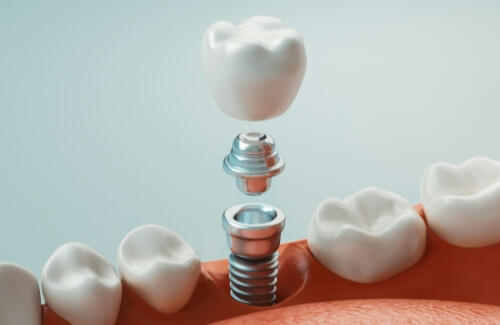 Illustrated dental implant with dental crown being placed into the lower jaw