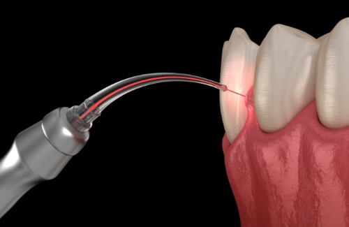 Illustrated dental laser treating gum disease