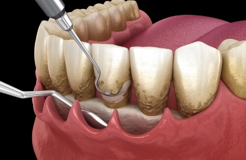 Illustrated dental instruments clearing plaque buildup from teeth