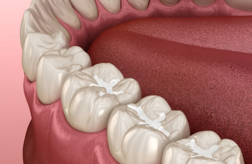 Illustrated row of teeth with dental sealants