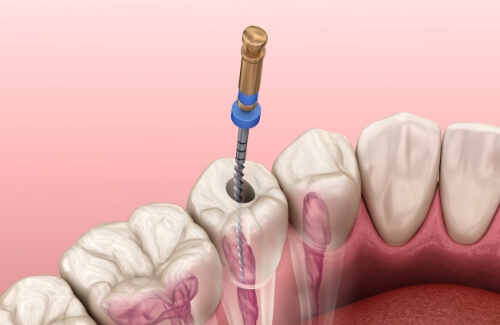 Illustrated dental instrument cleaning the inside of a tooth