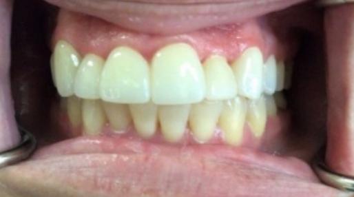 Close up of smile with whiter teeth after dental treatment