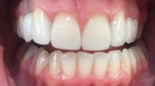 Smile with aligned teeth after orthodontic treatment