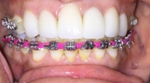 Smile with straight upper teeth and braces on lower teeth