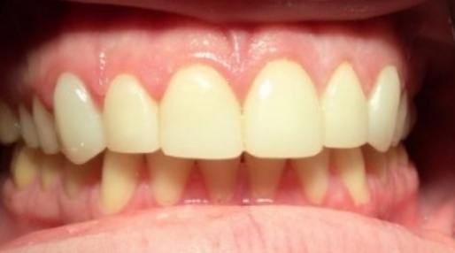 Smile after closing small gap between two front teeth