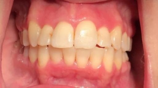 Close up of smile with yellowed teeth before treatment from Orem dentist