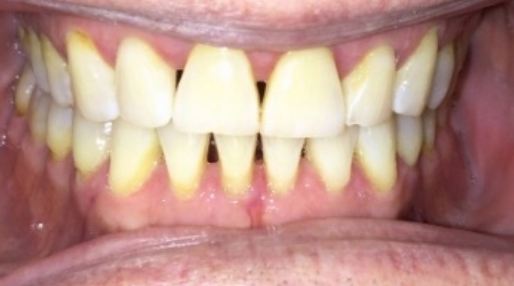 Smile with discolored and slightly gapped teeth