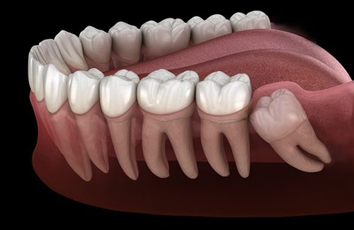 Illustration of impacted wisdom tooth
