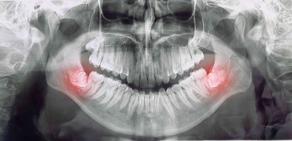 X-ray of impacted wisdom teeth