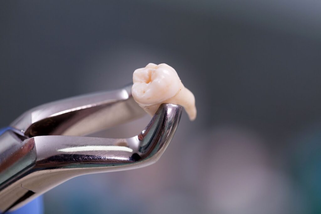 Large extracted tooth held by forceps