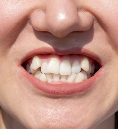 Close up of crooked teeth
